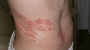 帯状疱疹の画像