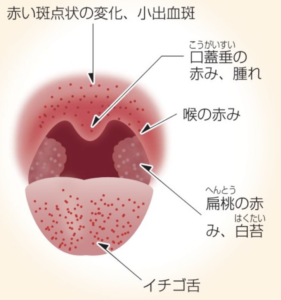 溶連菌　のどの所見