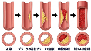 プラーク形成の画像です